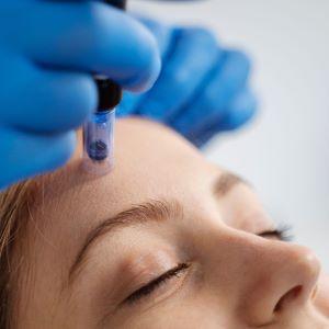 Microneedling Treatment
